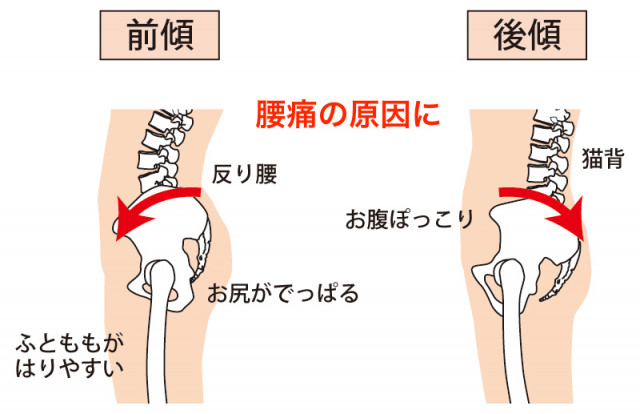 骨盤前湾・後弯