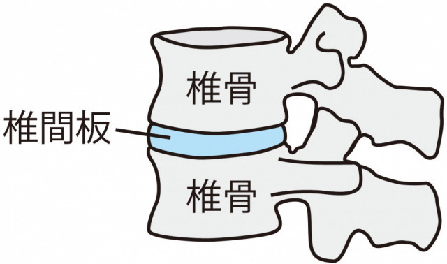 腰椎椎間板ヘルニアとは?